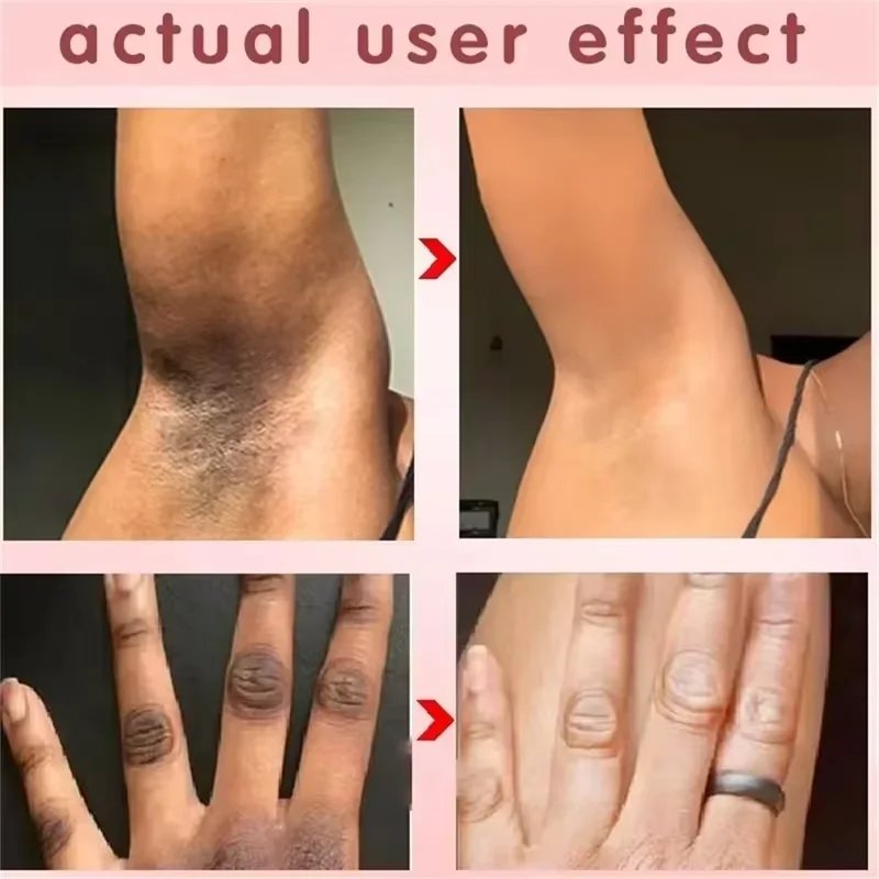 Nicotinamide Brightening Cream For Dark Skin Effective Lighten Thigh Inner Bleach Remove Melanin Private Parts Brighten Cream Nicotinamide Brightening Cream For Dark Skin Effective Lighten Thigh Inner Bleach Remove Melanin Private Parts Brighten Cream