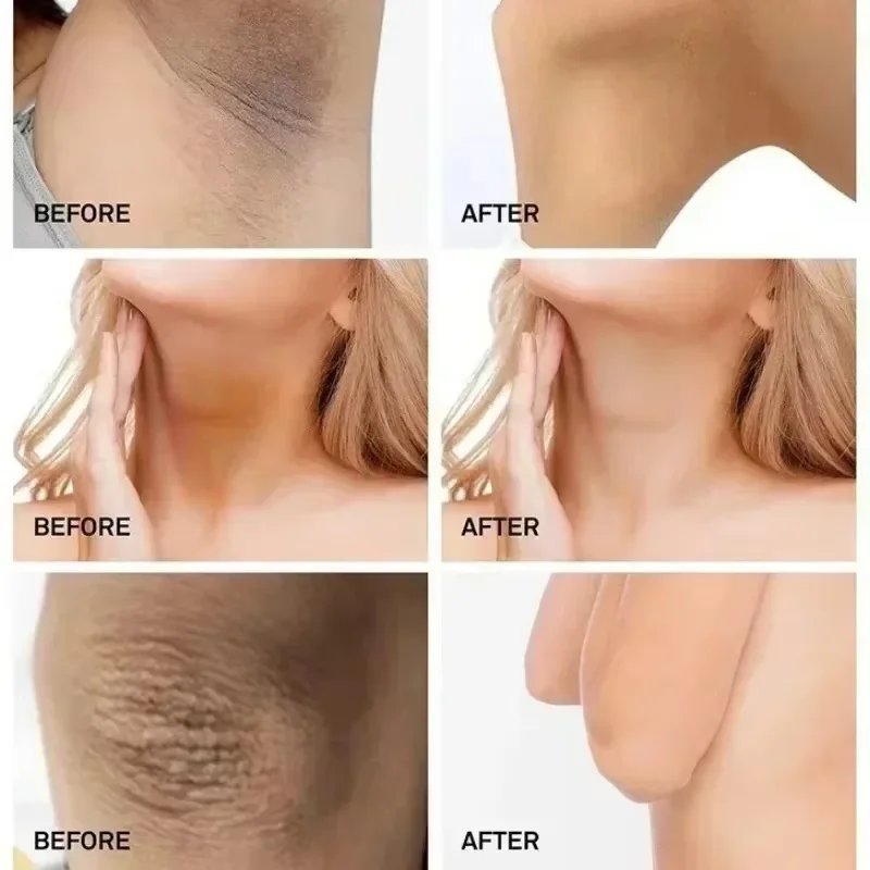 Nicotinamide Brightening Cream For Dark Skin Effective Lighten Thigh Inner Bleach Remove Melanin Private Parts Brighten Cream Nicotinamide Brightening Cream For Dark Skin Effective Lighten Thigh Inner Bleach Remove Melanin Private Parts Brighten Cream